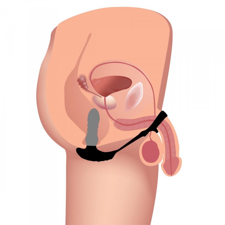 Thunderplugs 10x Enchufe de empuje con anillo para pene y bola